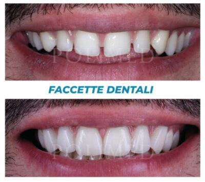 faccette-dentali_3_centropolimed-500x443